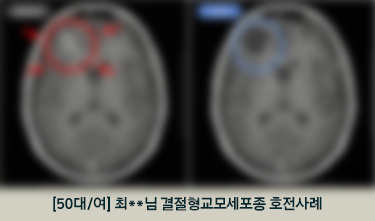 교모세포종 통합암치료 후 NED상태, ECOG 2->1, 수면시간 3->6시간, 체중 4KG 증가 호전후기