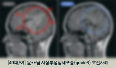 성상세포종 통합암치료 후 NED상태, 치료기간 동안 체중 증가 4kg, ECOG 3->1 호전후기